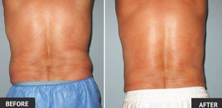 LIPOSUCTION: How does it work?