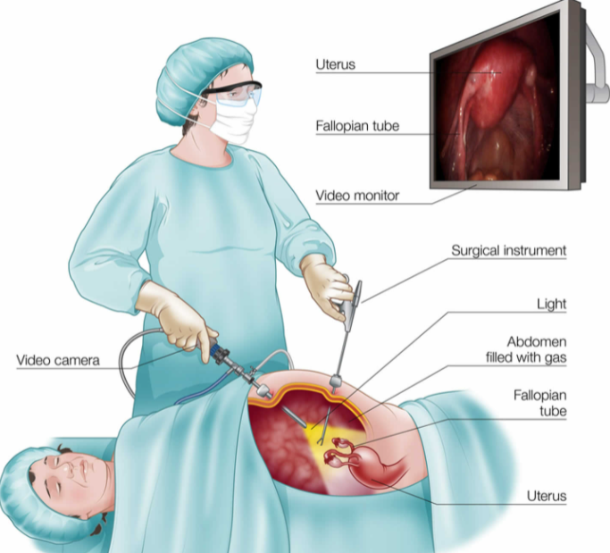 LAPAROTOMY: Here are some important things to know